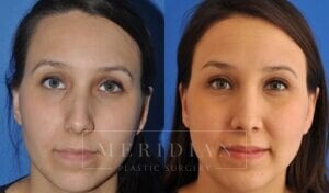 tjelmeland-meridian-austin-rhinoplasty-patient-3-2