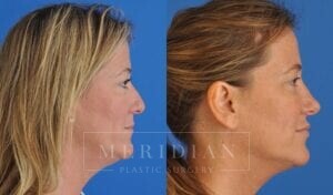 tjelmeland-meridian-austin-rhinoplasty-patient-4-1