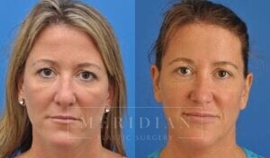 tjelmeland-meridian-austin-rhinoplasty-patient-4-2