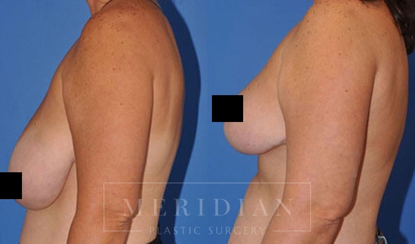 tjelmeland-meridian-austin-breast-augmentation-patient-36-2censored